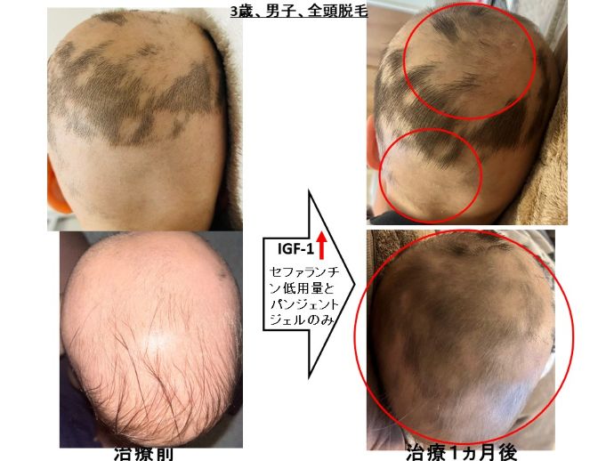 円形脱毛症　病院
